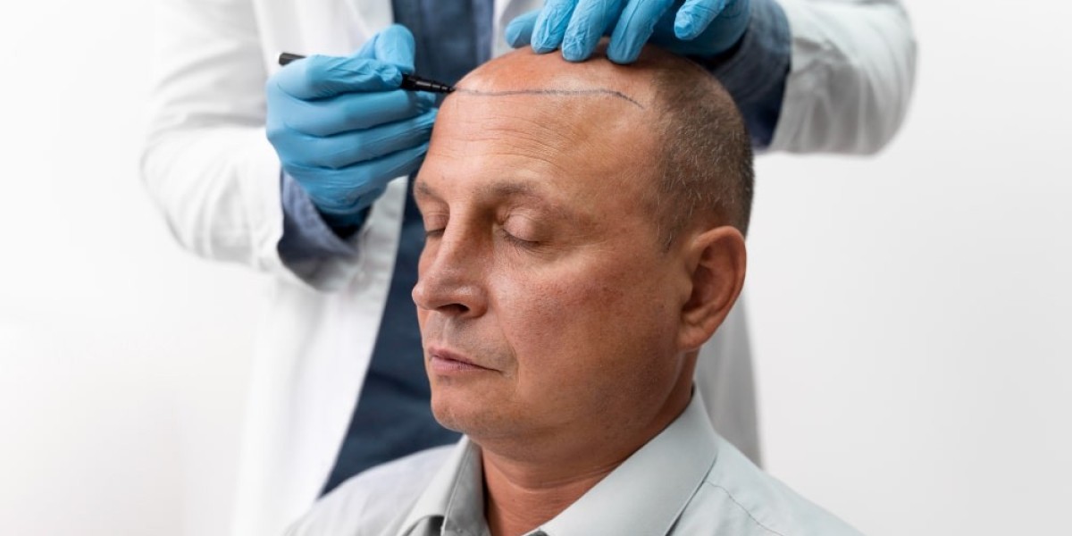 Hair transplant for temples & receding hairlines: specialized focus in Islamabad