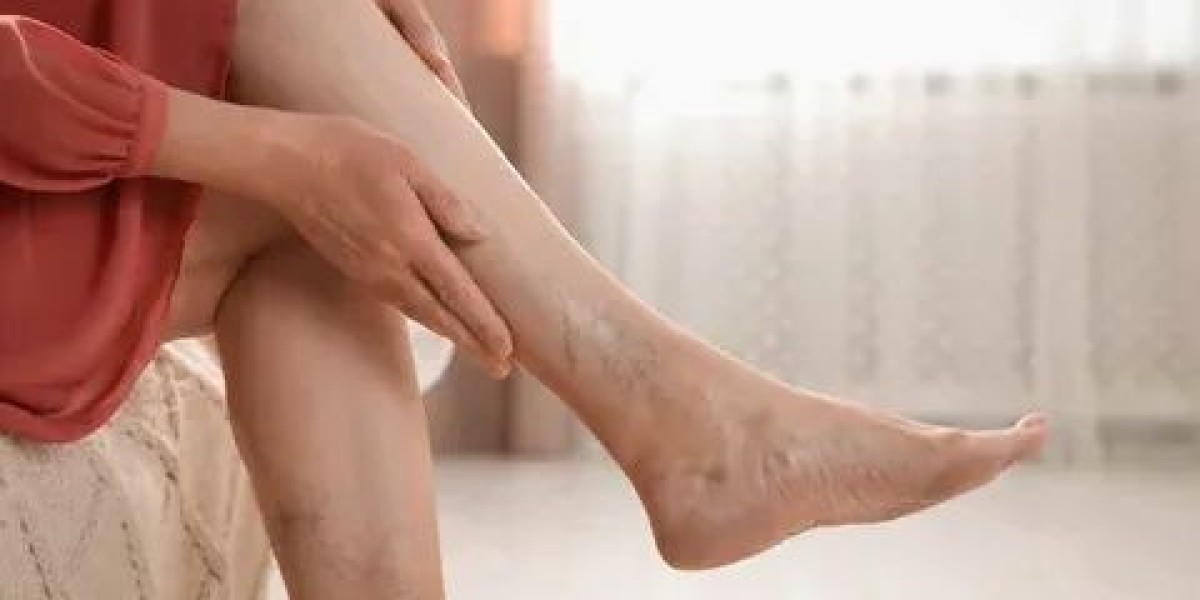 Can Varicose Veins Lead to Blood Clots?