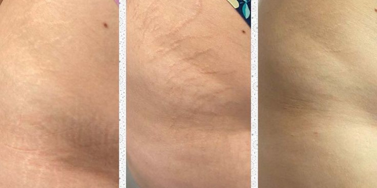 Top Techniques You’ll Learn in Professional Stretch Mark Camouflage Courses