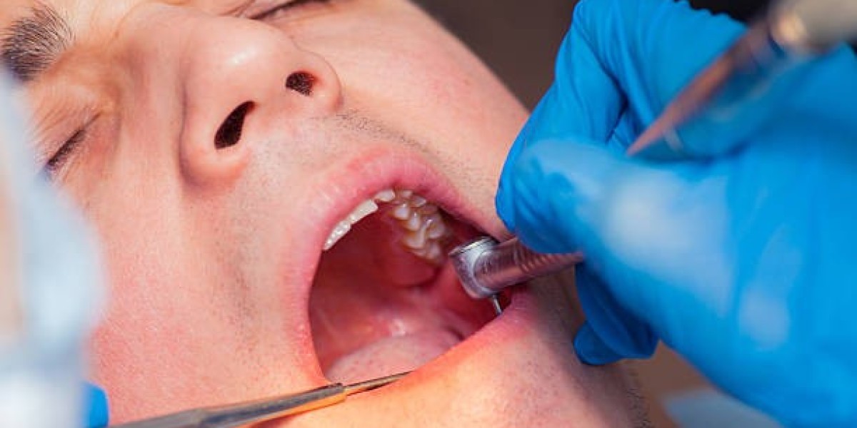 Understanding Tooth Extractions: What to Expect During Tooth Removal