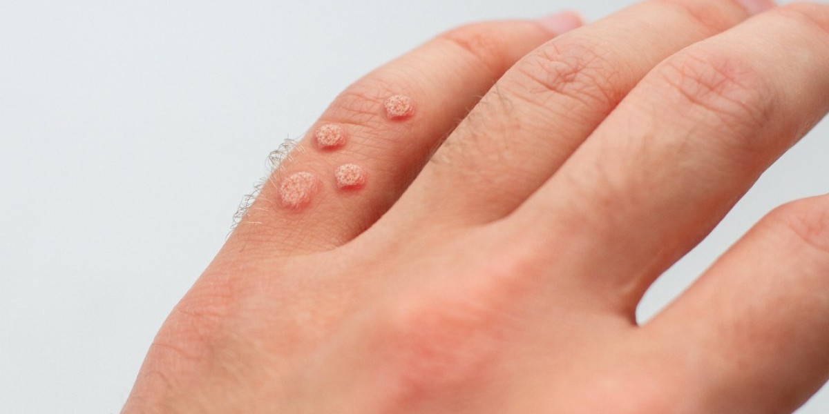 Why Some People Prefer Warts Removal Treatments in Dubai