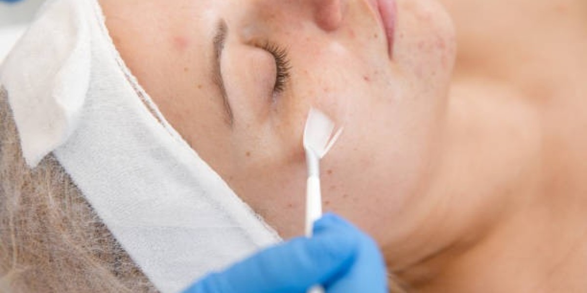 Enhance Smoothness and Radiance Through Chemical Peel