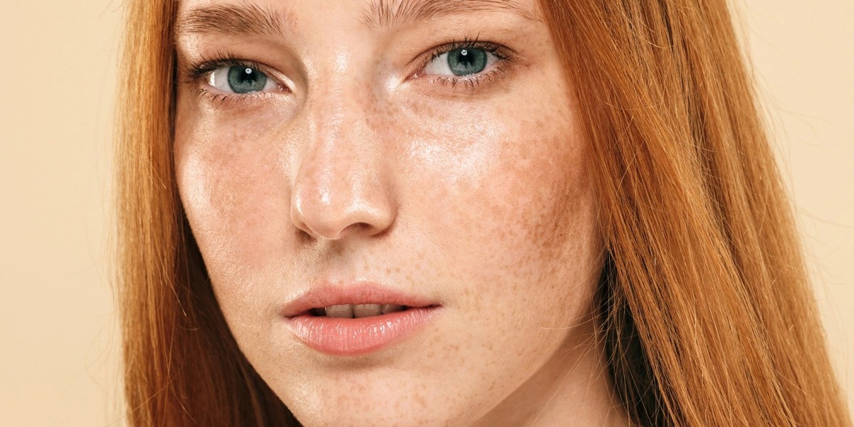 How to Support Healing After Melasma Treatment?