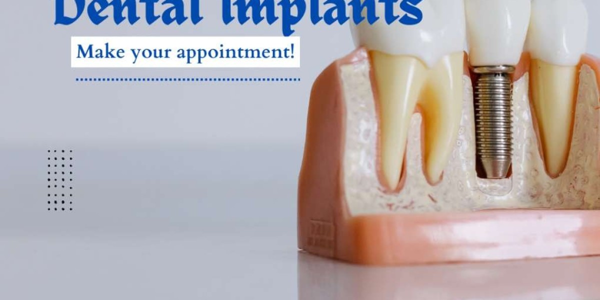 Full Month Dental Implants – Your Complete Guide to a Permanent Smile