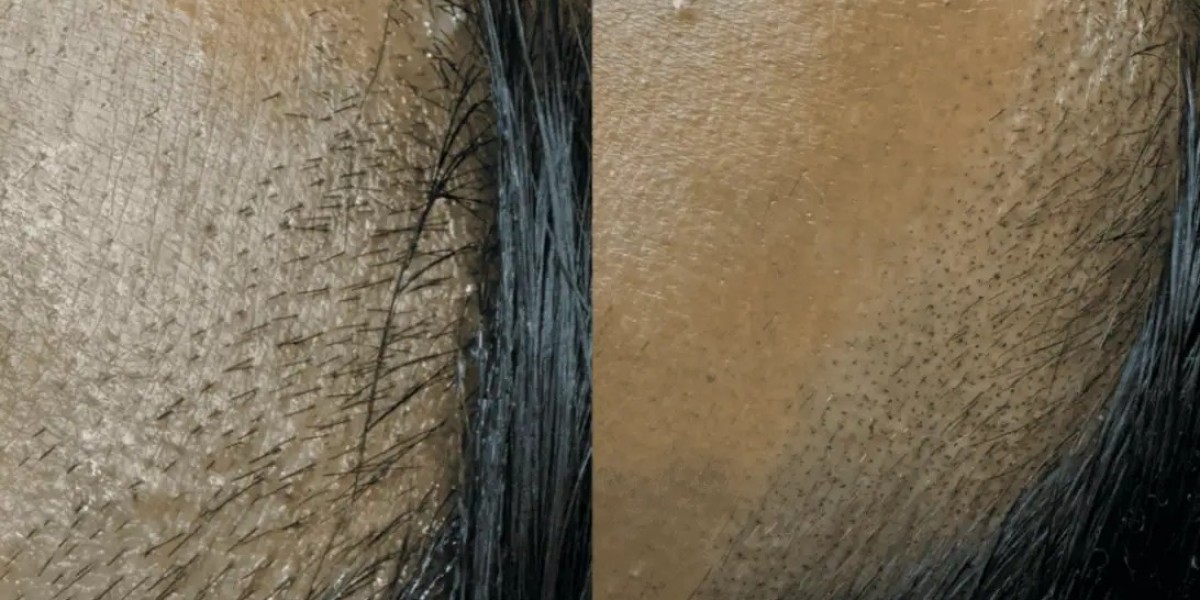 What to Expect During Your Scalp Micropigmentation Vancouver Treatment