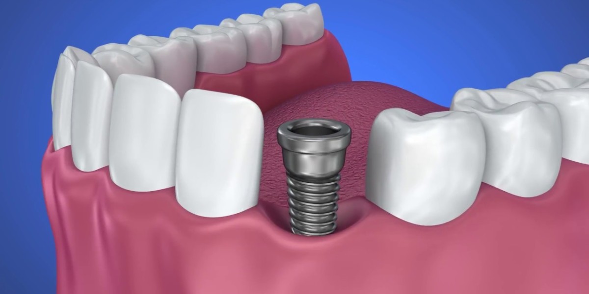 Dental Implants In Dallas- Restore Your Smile With Expert Care