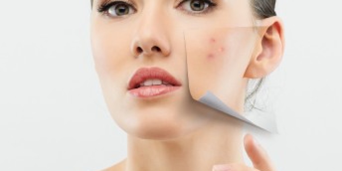 Understanding Vascular & Rosacea Laser Treatment: How It Works